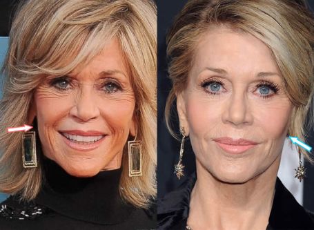Jane Fonda before and after plastic surgery.